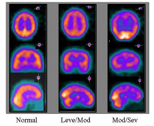 Tomografías cerebrales